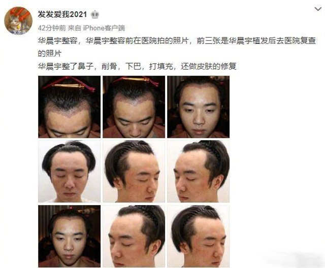 plastic surgery photos of Hua Chenyu.